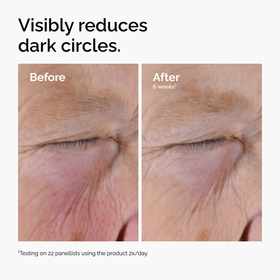caffeine-solution-5-egcg-eye-serum-r5 ord-caffeine-solution-egcg-dark-circles-before-after.jpg