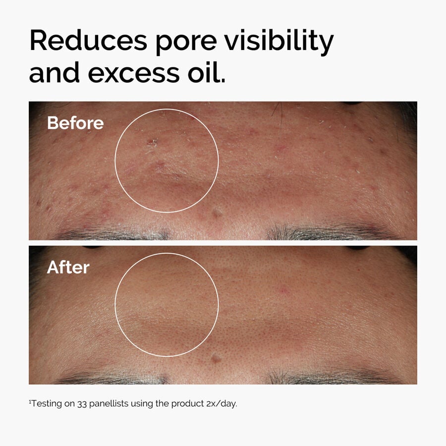 niacinamide-10-zinc-1-h0 ord-niacinamide-zinc-blemish-serum-before-after-pores.jpg