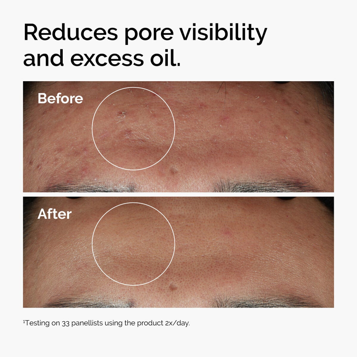niacinamide-10-zinc-1-h0 ord-niacinamide-zinc-blemish-serum-before-after-pores.jpg
