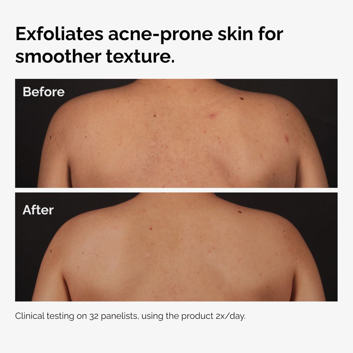 salicylic-acid-0-5-body-serum-k7 ord-salicylic-acid-body-serum-before-after-graphic-NA.jpg