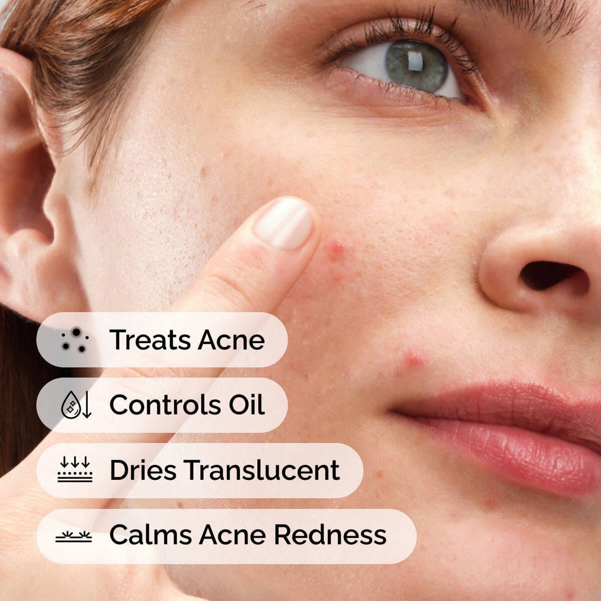 sulfur-10-powder-to-cream-concentrate-h9 ord-sulfur-10pct-powder-to-cream-concentrate-model-application-with-benefits-acne.jpg