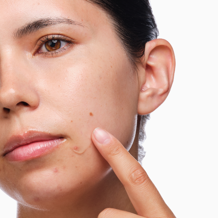 the-acne-set-g8 rdn-the-acne-set-application.png